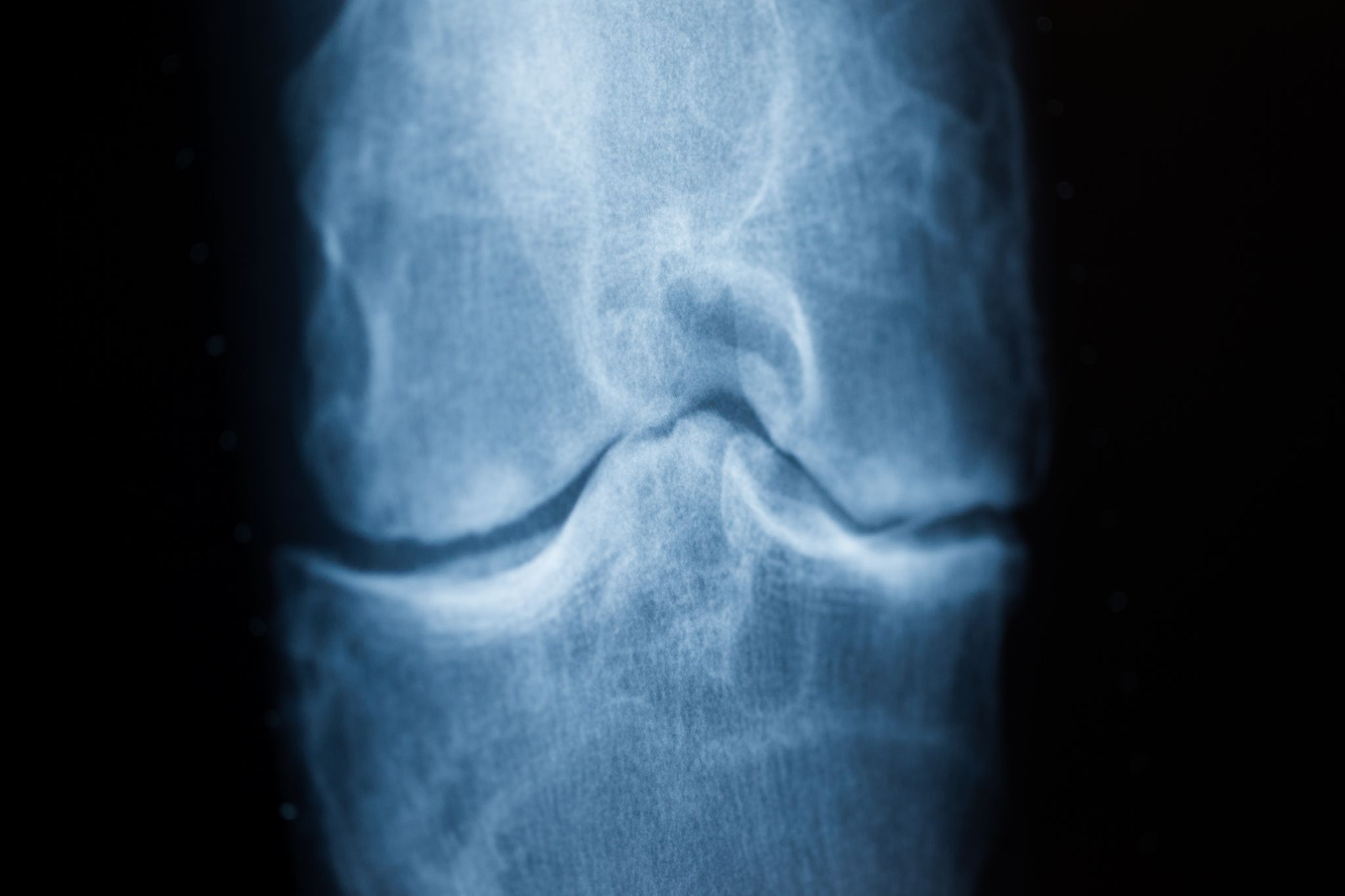 Rheuma-Aktionsplan soll Diagnose und Therapie beschleunigen