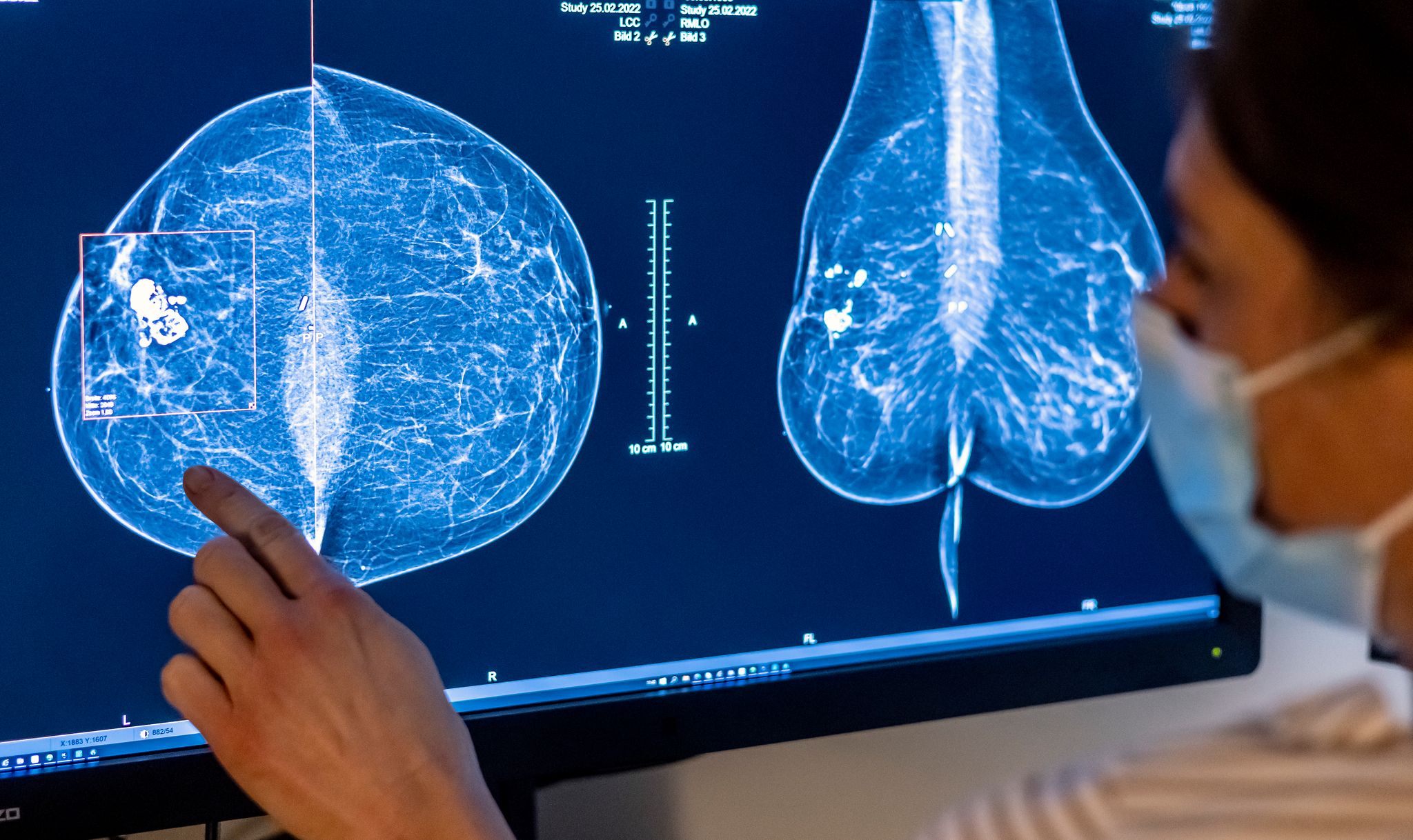 Krankenkasse: Brustkrebs bei Frauen wird häufiger