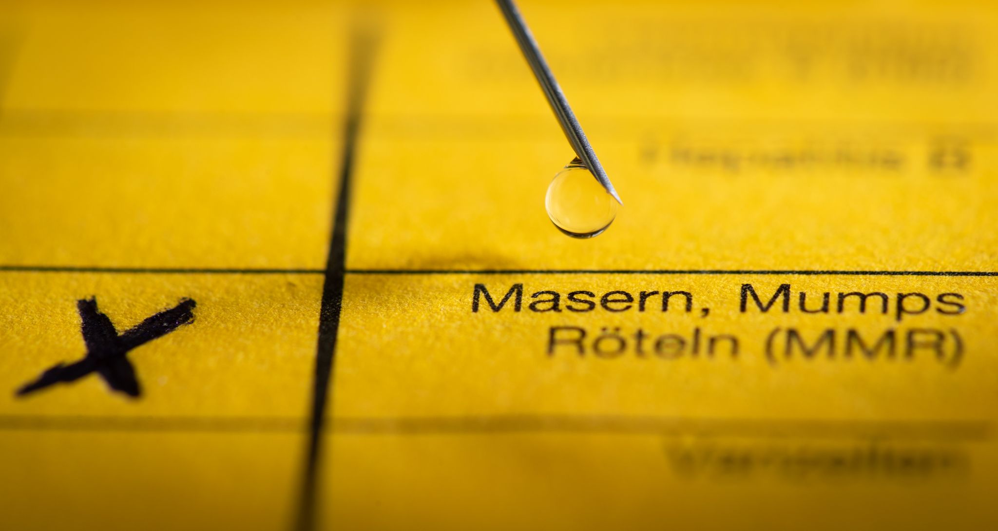 Mehr Masern in Karlsruhe - Fälle auch in Rheinland-Pfalz Mehr Masern in Karlsruhe - Fälle auch in Rheinland-Pfalz